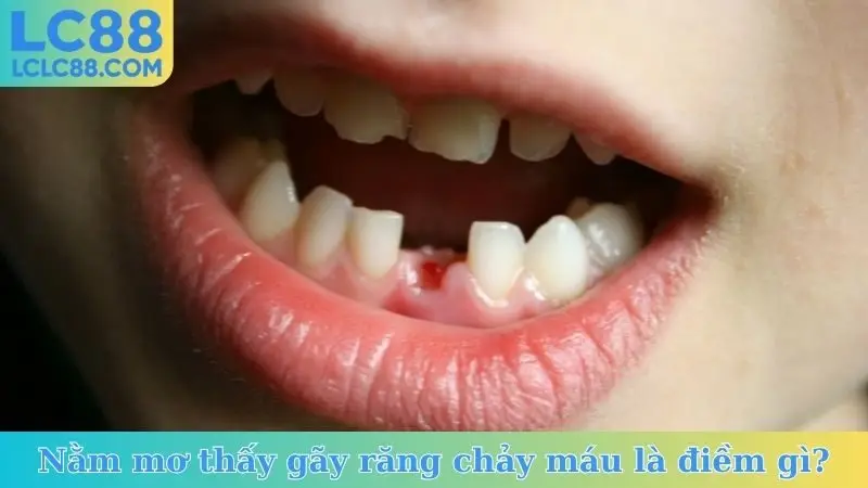 Nằm mơ thấy gãy răng chảy máu là điềm gì?